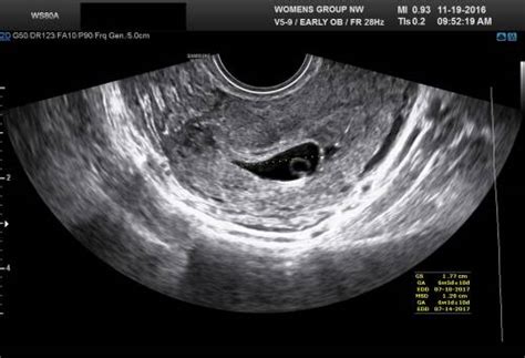 early pregnancy ultrasound 4 weeks paper my xxx hot girl