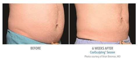 Coolsculpting Before And After Real Patient Results