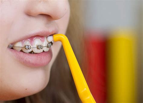 braces  oral hygiene keeping  clean orthodontic associates