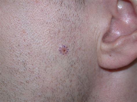 acd    skin basal cell carcinoma bcc