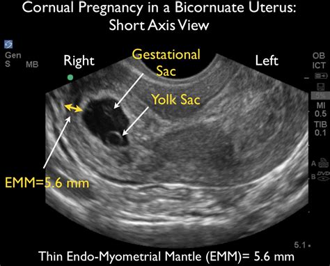 ultrasound leadership academy ultrasound  early pregnancy em curious