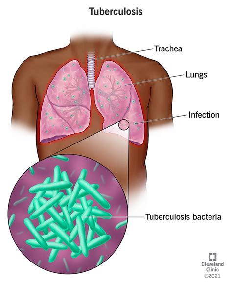 tuberculosis  symptoms diagnosis treatment