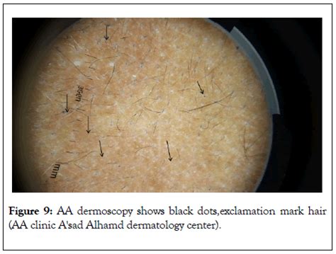 alopecia areata  kuwaiti patients  dermoscopy view