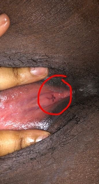 is this genital warts genital herpes simplex forums