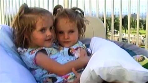 the miracle conjoined twins who survived a 26 hour separation surgery
