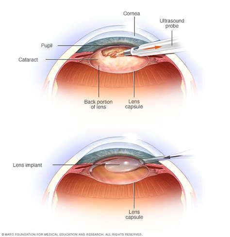 cataract surgery mayo clinic
