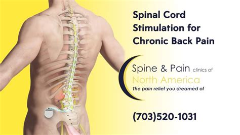 spinal cord stimulation sapna spine  pain clinic  north america