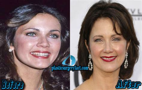 Lynda Carter Plastic Surgery Before And After Photos
