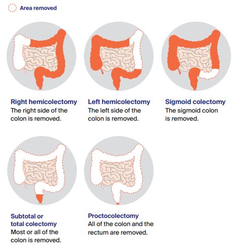 Treatment For Early Bowel Cancer Cancer Council Victoria