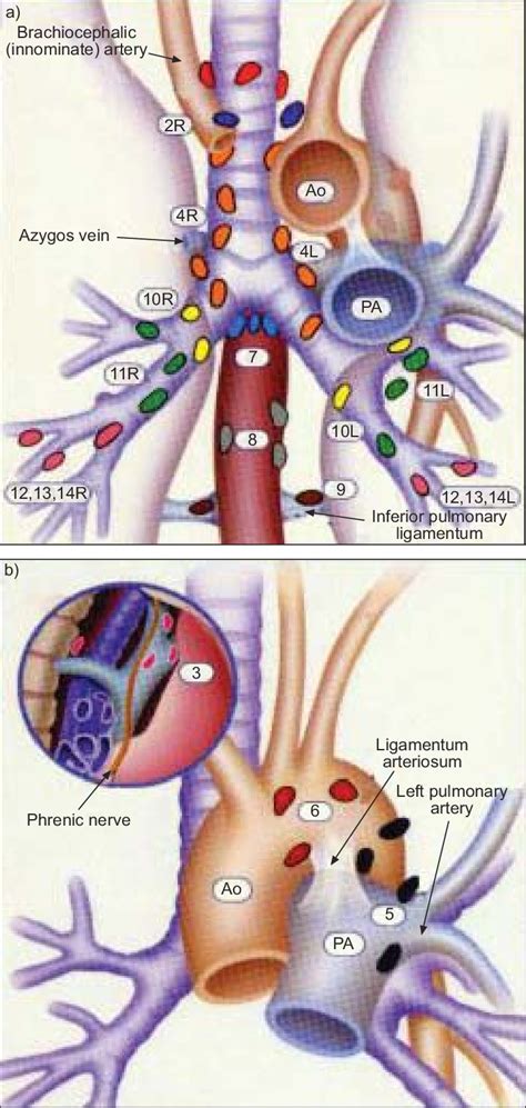 Mediastinal And Hilar Lymph Node Map For Lung Cancer