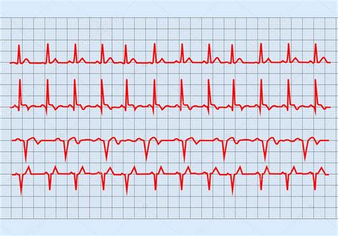 Gráfico Ekg El Corazón Electrocardiograma Gráfico En Forma De Papel 2023