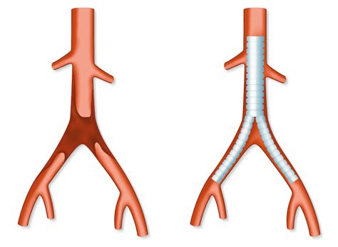 aortenverschluss und  prothese tauchende