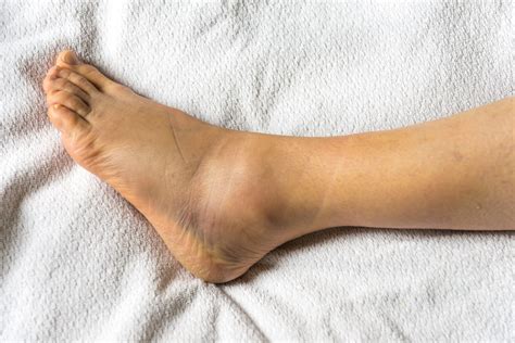 10 causes for swollen feet why your ankles legs swell