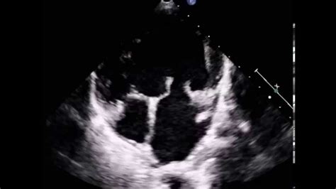 single ventricle  left ventricular morphology youtube