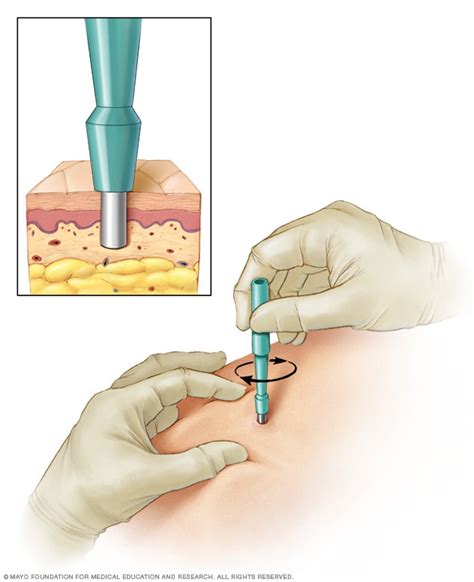 biopsia de piel mayo clinic