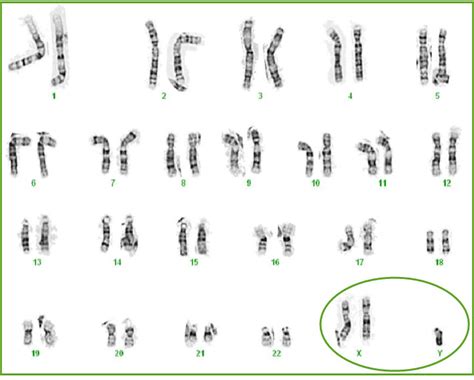 Klinefelter Syndrome Chromosomes