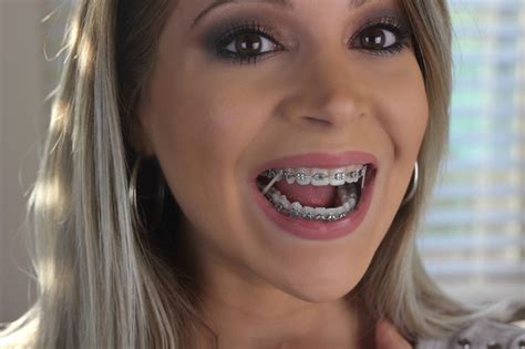 adult braces month 11 update expanders and elastics