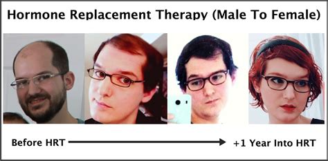 Exactly How Trans Hormone Replacement Therapy Regrows Hair