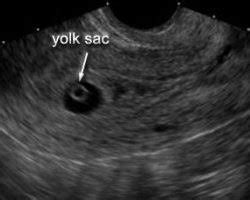 yolk sac somerset early scans