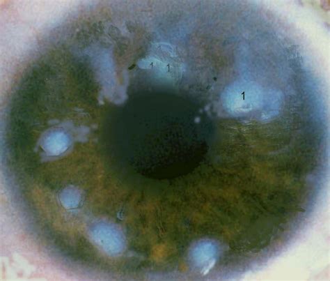 ocular pathology salzmanns nodular degeneration   cornea