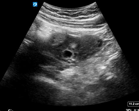 ectopic critical care sonography