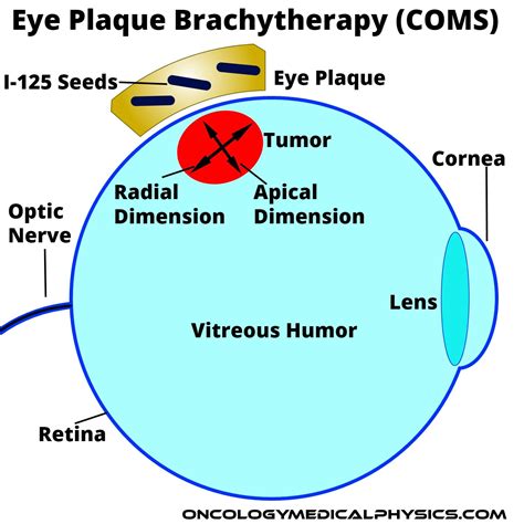 ocular brachytherapy oncology medical physics