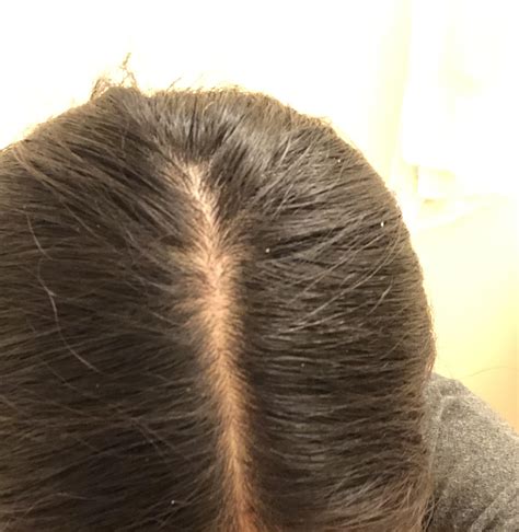 normal hair part rfemalehairloss