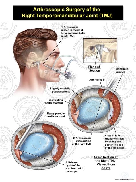 arthroscopic surgery  temporomandibular joint tmj medical illustration