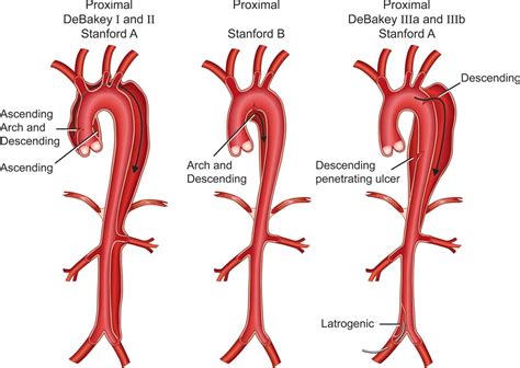 management  acute aortic syndromes