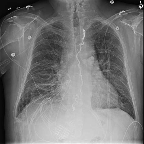 Chest X Ray Of A Patient With History Of Pleural Effusion Bmj Case