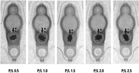 Determining Settings Of Programmable Vp Shunts Uw Emergency Radiology