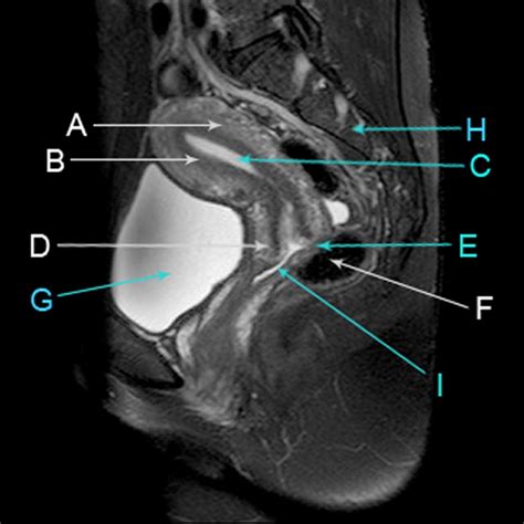 sagittal t2 weighted magnetic resonance image of the female pelvis