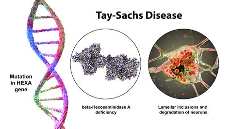 Tay Sachs Disease Photograph By Kateryna Kon Science Photo Library Pixels