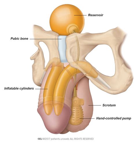Penile Prosthesis Manufacturers Urology News Medium