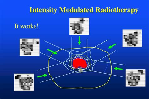 ppt intensity modulated radiotherapy and inverse planning powerpoint