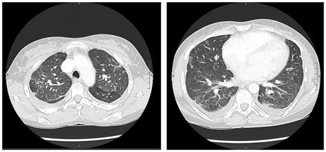 Thorax Computed Tomography Scan Demonstrating Bilateral Interstitial