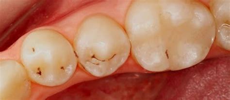 zwarte stipjes tanden tandartsnl forum
