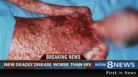 Warning New Deadly Disease Worse Than Hiv And Condoms