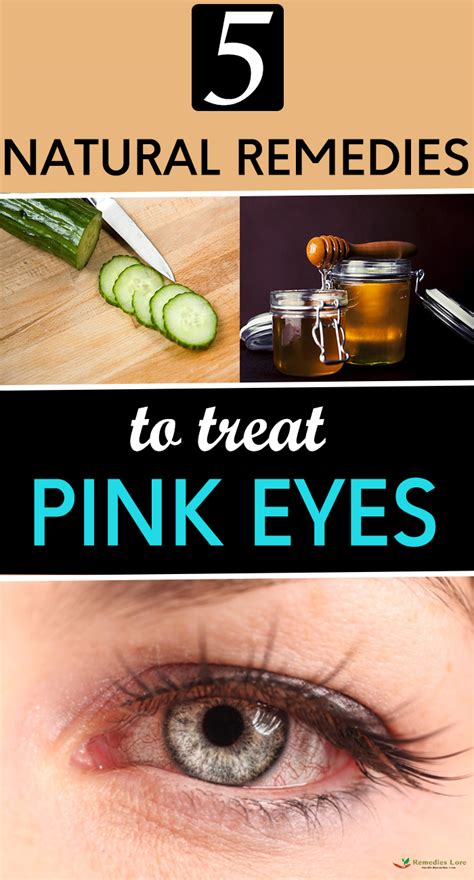 natural remedies  treat pink eyes remedies lore