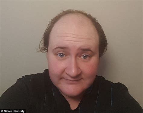 woman who went bald at just 20 says gluing £250 hairpieces to her scalp