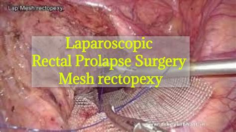 rectal prolapse laparoscopic mesh rectopexy rectal prolapse surgery