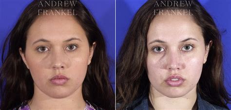 buccal fat removal  beverly hills ca patient