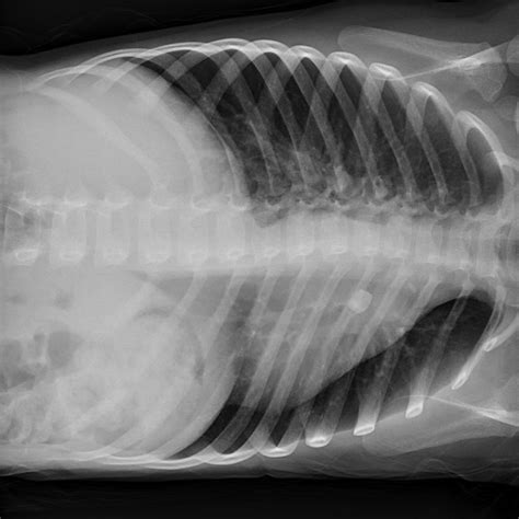 screwy case  pediatric shortness  breath brown emergency medicine