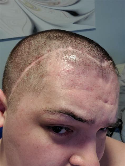 brain surgery scar   woke    coma    staples   stitches