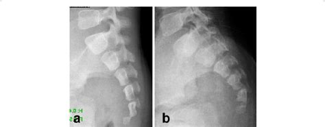 lateral radiograph   sacrum  coccyx obtained  days
