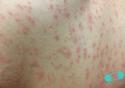 spots  rashes caused  viruses  dermatology