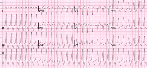 dr smiths ecg blog regular wide complex tachycardia