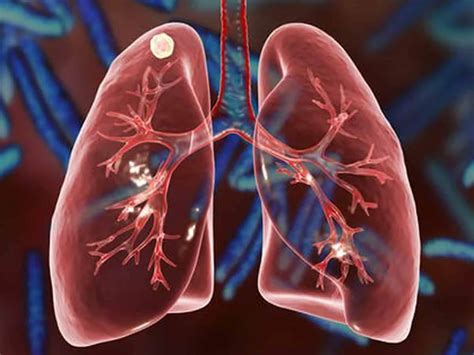 cells damaged  chronic lung disease  result  severe covid