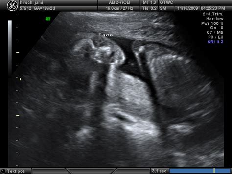 lola nicole hirsch 19 weeks ultrasound