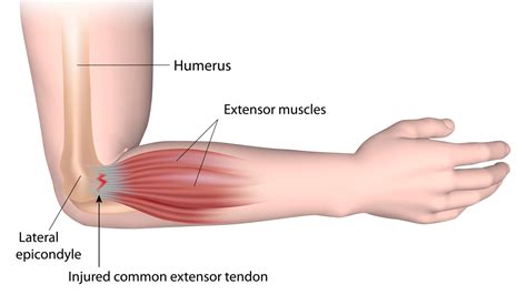 physiotherapy  elbow  forearm pain glebe physio